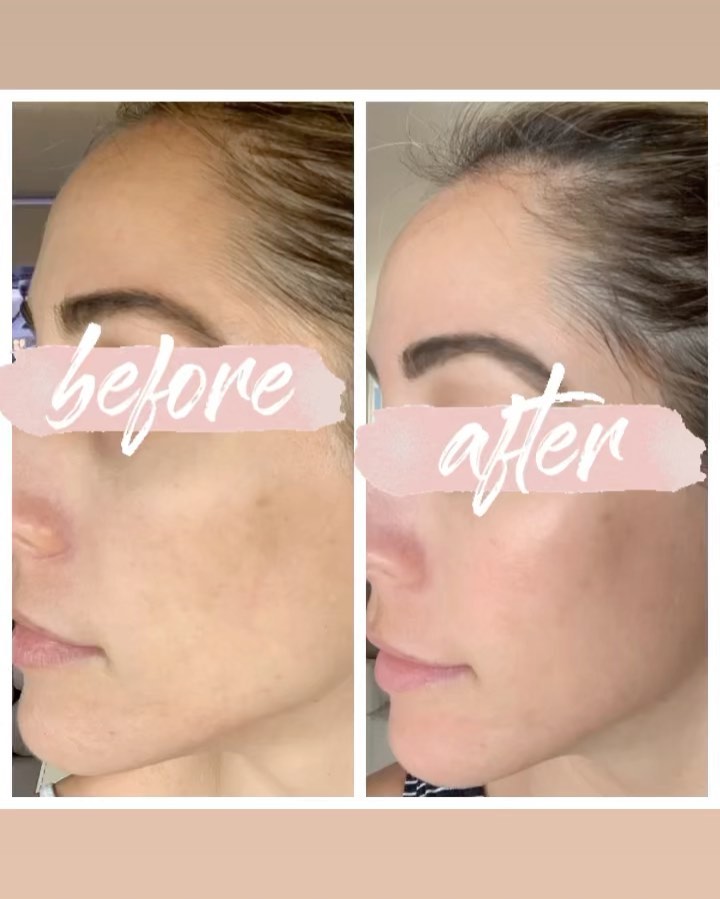PRP facial before and after result