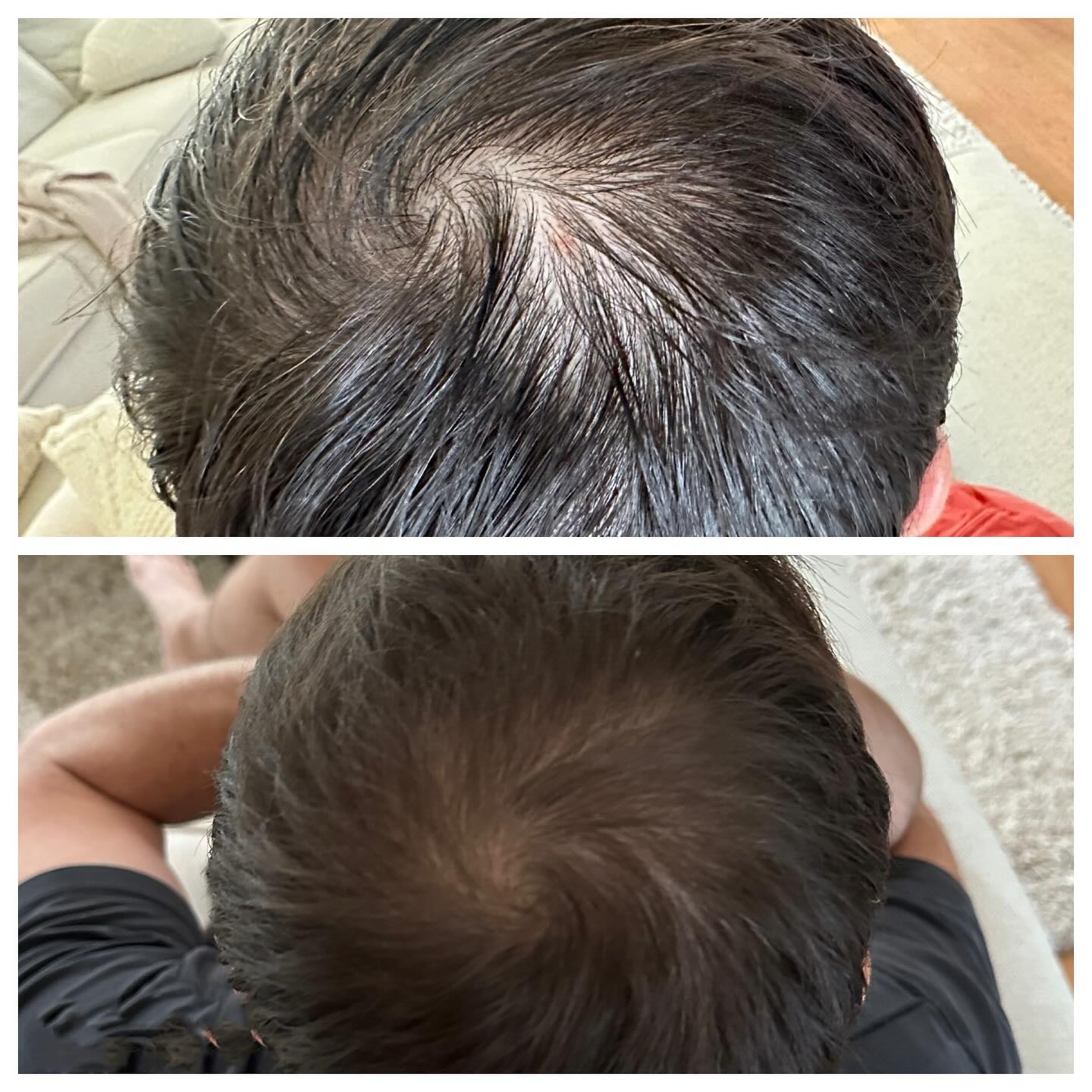 PRP hair restoration before and after