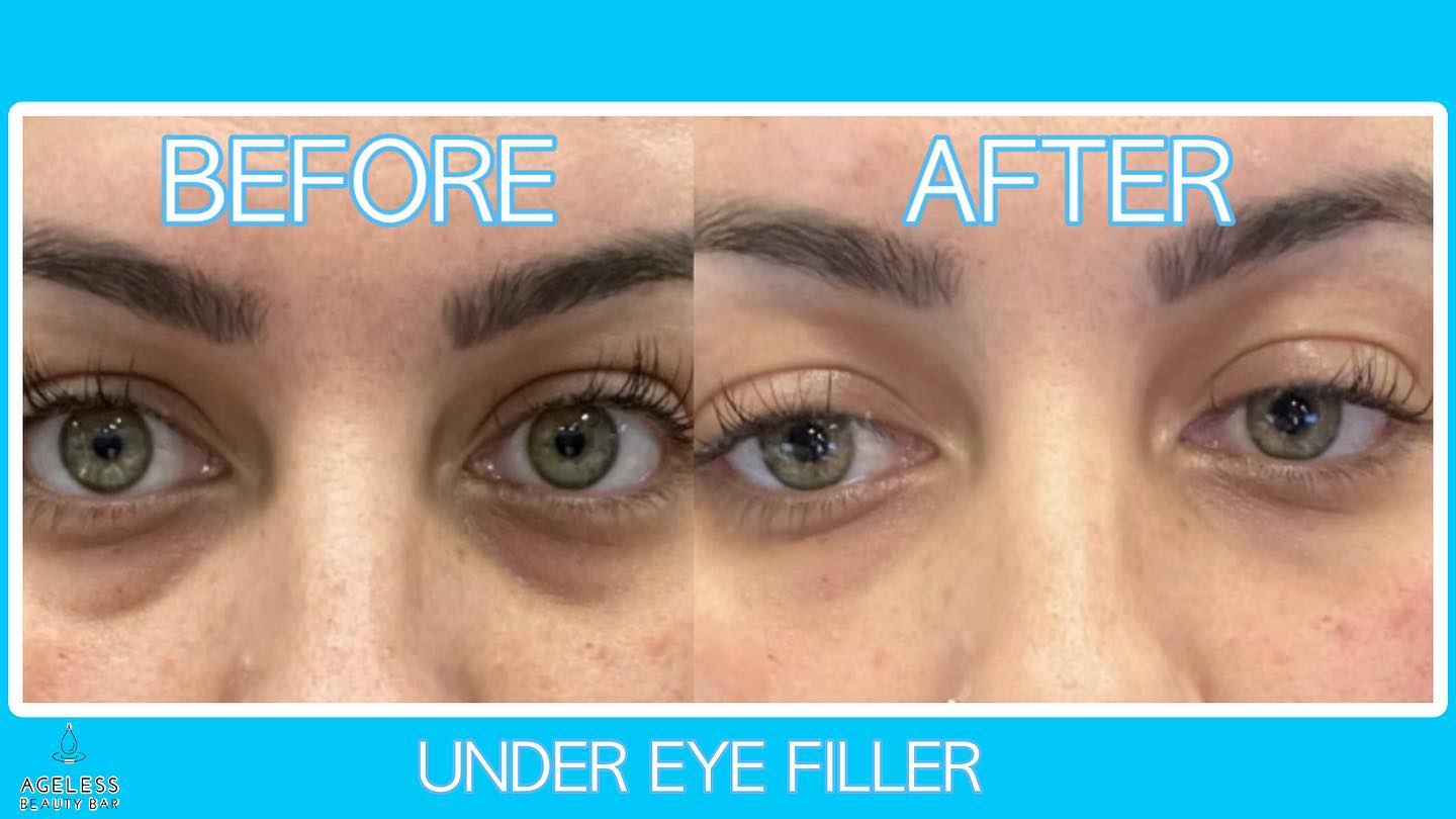 Under-eye filler before and after