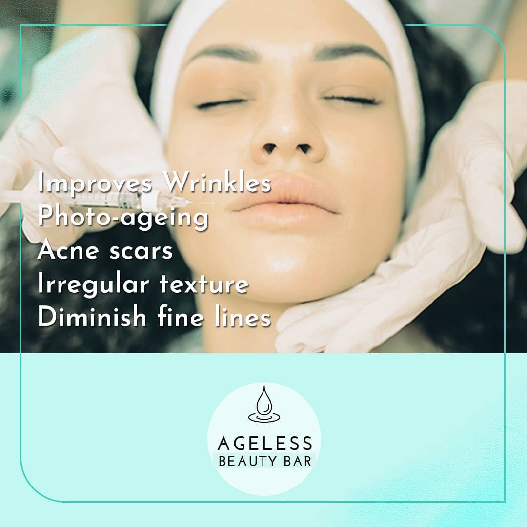 PRP facial treatment graphic